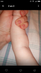 Сыпь без диагноза у ребёнка на ступенях и ладонях фото 1