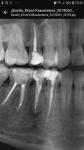 Хронический переодонтит, возможно ли спасти зуб? фото 2