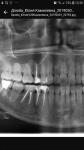 Хронический переодонтит, возможно ли спасти зуб? фото 1