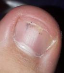 Черное размытое пятно под ногтем большого пальца ноги фото 1
