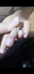 Опухоль на пальце у ребёнка 5 лет фото 2