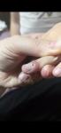 Опухоль на пальце у ребёнка 5 лет фото 1