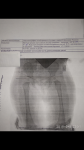 Дисплазия асимметрия углов тазобедренных суставов фото 2