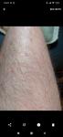 Сыпь на голенях, зудит, аллергия фото 2