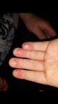 Шелушение и трещины на пальцах и ладонях фото 1
