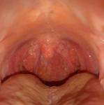 Болит горло и язык фото 5