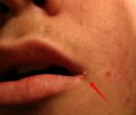 Болячка белая в уголке губы, переодически появляется фото 1