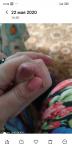 Трещины на пальце у ребенка фото 4