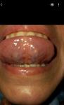 Болит язык, лимфоузлы фото 2