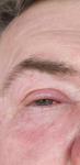 Повреждение широкой роговицы глаза фото 1