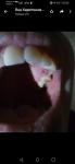 Розовый зуб и образование на зубе фото 1