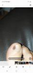 Темное пятно на ногте пальца ноги фото 1