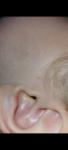 Шишки на носу у ребенка фото 5