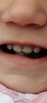 Сернеют зубы, белые пятна на зубах фото 1