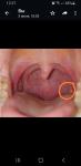 Хронический тонзилит частая боль в горле фото 1