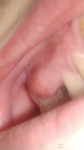 Шишка на десне, не болит, возле корня зуба, иногда кровоточит фото 3