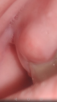 Шишка на десне, не болит, возле корня зуба, иногда кровоточит фото 2