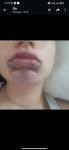 Отёк губ, синий подбородок, герпес, аллергия фото 5