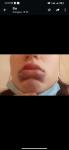 Отёк губ, синий подбородок, герпес, аллергия фото 4