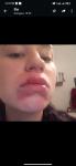 Отёк губ, синий подбородок, герпес, аллергия фото 3