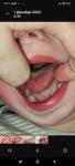 Серый налет на языке у ребенка фото 2