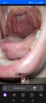 Воспаление слизистой горла фото 2