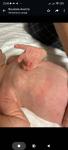 Сыпь на теле новорожденной фото 1