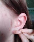 Пухлина чи прищ на мочці вуха, що робити? фото 1