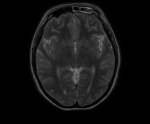 Опухоль мозга фото 1