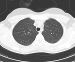 Проблемы с дыханием, кт грудной клетки фото 3