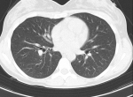 Проблемы с дыханием, кт грудной клетки фото 5