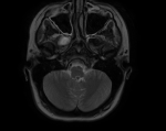 Опухоль мозга фото 2