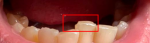Скол на эмале зуба фото 1