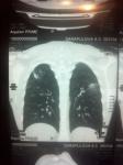 Подозрение на пневмонию на КТ фото 3