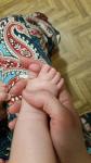 Синдактилия 2 и 3 пальцев у ребенка а ноге фото 1