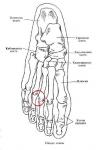 Неправильно сросшийся кость пальца ноги между 2 и 3 пальцами фото 1