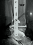 Осколок малоберцовой кости после остеозинтеза лодыжки фото 2