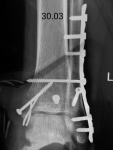 Осколок малоберцовой кости после остеозинтеза лодыжки фото 3