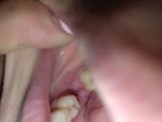 Болит зуб после удаления фото 1