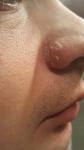 Шелушение кожи возле носа, подбородок фото 1