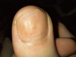 Светло коричневое пятно на ногте на ноге фото 2