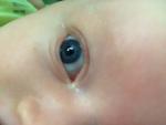 Темные пятна на глазном яблоке у двухмесячного ребенка фото 1