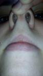 Безболезненая шишка в носу фото 2