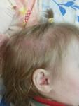 Сыпь на голове у ребенка фото 1
