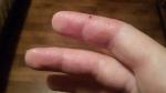 Повреждение кожи на пальце фото 2