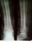 Перелом ноги фото 1
