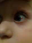 Травма глаза у ребенка фото 2