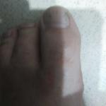 Проблема с ногтями трещины на пальце большем ноге и руке фото 2