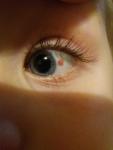 Травма глаза у ребенка фото 1