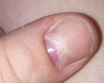 Проблемы с ногтем фото 3